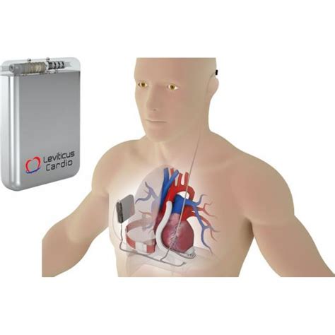 Implantable battery milestone toward Leviticus Cardio U.S. LVAD Trial - EIN Presswire