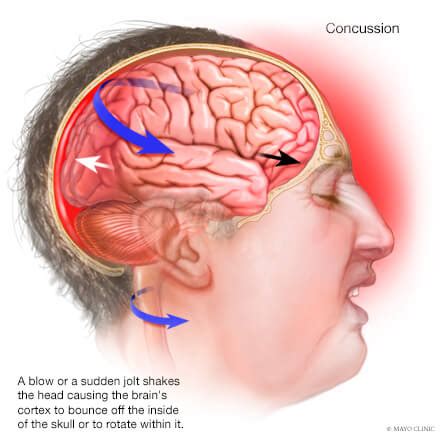 Concussion - Overview - Mayo Clinic Orthopedics & Sports Medicine