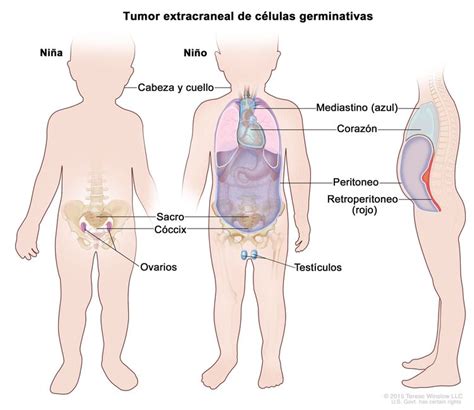 Tratamiento de los tumores extracraneales de células germinativas en la niñez (PDQ®)–Versión ...