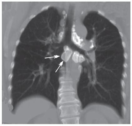 SciELO - Brasil - Lymph node calcifications Lymph node calcifications