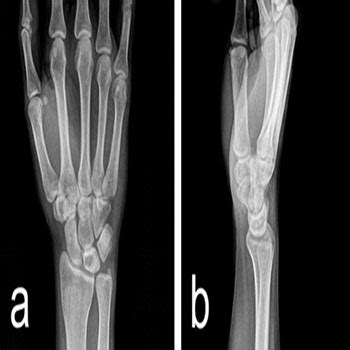 Intraosseous Ganglion Cyst of The Lunate Bone: Two Case Reports with Literature Review