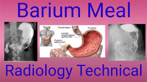 Barium Meal Procedure / upper GI series Complete Examination || By BL Kumawat - YouTube