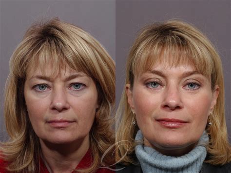 Mid Facelift for Rochester, Buffalo & Syracuse, NY | Quatela Center for Plastic Surgery