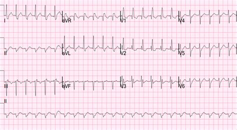 Dr. Smith's ECG Blog: Paroxysmal SVT (PSVT) that repeatedly recurs in spite of successful ...