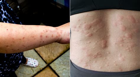 Can Bed Bug Bites Cause Rashes – Pest Phobia