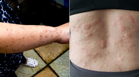 Can Bed Bug Bites Cause Rashes – Pest Phobia