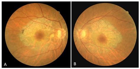 (A) Color fundus image of the right eye; (B) color fundus image of the ...