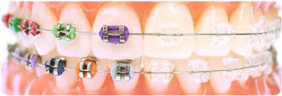 Damon™ System self-ligating brackets - for an extraordinary smile at any age!