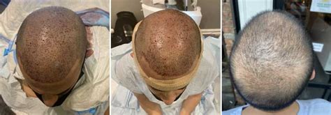 20+ Exosomes Hair Loss Before And After - KasonKeemaya