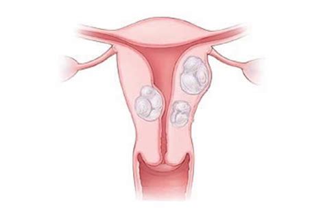 Miomatosis Uterina | Dr Castillo Palacios