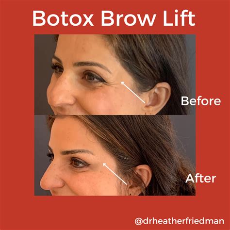 The Brow Lift Blog — Dr. Heather Friedman ND, LAc