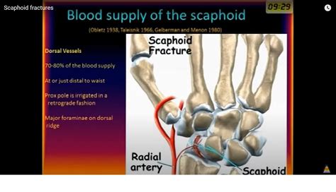 Scaphoid Fracture Types