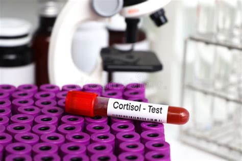 Cortisol Test To Look for Abnormalities from Blood Stock Photo - Image ...