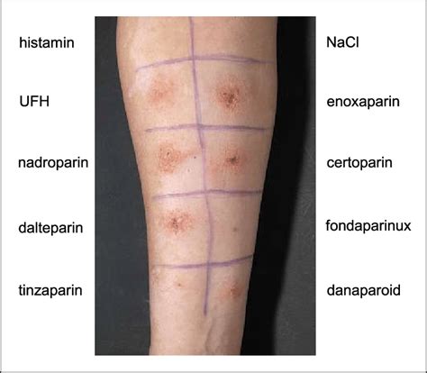 Heparin Injection Sites