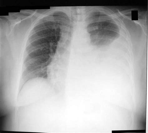 Pleurisy In Chest X-Ray: Various Radiographs To Show And Depict This ...