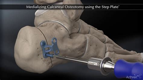 Medializing Calcaneal Osteotomy using the Step Plate™ - YouTube