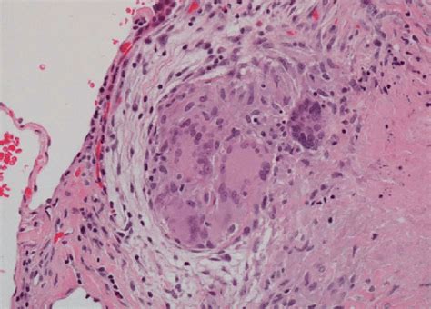 Figure5.Histological findings of the lung specimen showed granulomatous... | Download Scientific ...