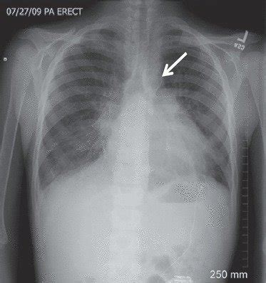 Chest X-ray demonstrating calcification of the aortic knuckle ...