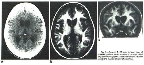 [PDF] Magnetic resonance imaging in Huntington disease. | Semantic Scholar