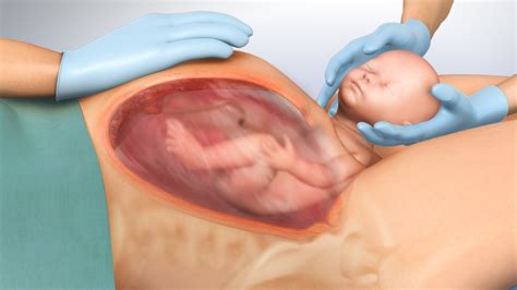 Postpartum Hemorrhage Animation - CAST PHARMA