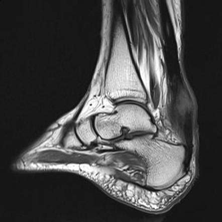 Achilles tendinopathy | Radiology Reference Article | Radiopaedia.org