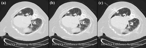 Lung nodule biopsy with low dose CT guidance protocol. Single images... | Download Scientific ...