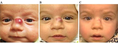 infant hemangioma - pictures, photos