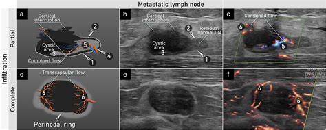 Terms, definitions and measurements to describe sonographic features of lymph nodes: consensus ...