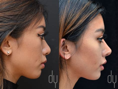 Before and After Revision Asian Rhinoplasty with rib cartilage and DCF (diced cartila ...