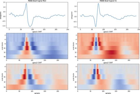 11 Two channel ECG of RBBB beat and output of applied CWT | Download Scientific Diagram