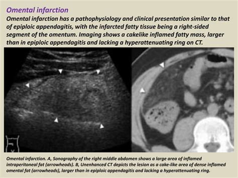 Presentation1.pptx, ultrasound examination of the appendix. | PPT