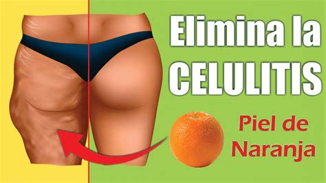 CELULITIS o LIPODISTROFIA 🍊 ¿Cómo ELIMINAR la PIEL de NARANJA? 👙 Dr ALBERTO CALVO QUIROZ - YouTube