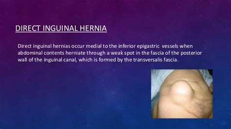 Case study on inguinal hernia