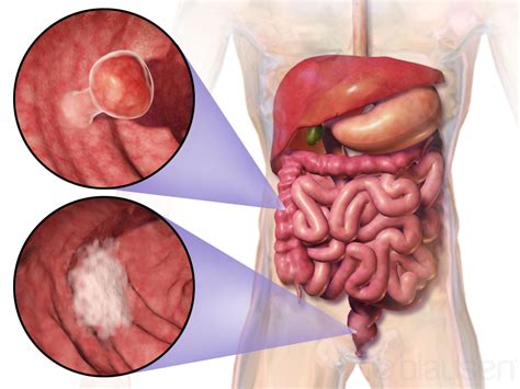 Colorectal cancer - Wikipedia