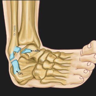 This figure shows a combined rupture of both Anterior TaloFibular ...