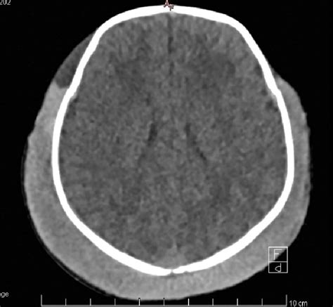 Subgaleal hemorrhage on CT scan, axial view: 13 mm hyperdense... | Download Scientific Diagram