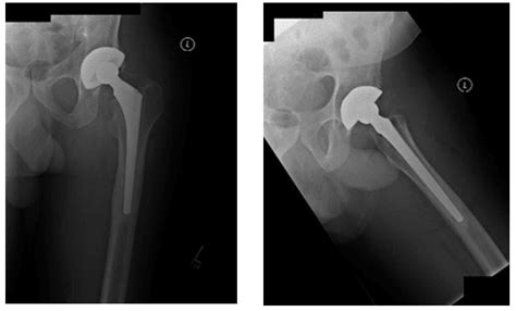 Loosening Left Total Hip Arthroplasty | NY, USA