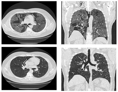 Medicina | Free Full-Text | Massive Spontaneous Pneumomediastinum—A Form of Presentation for ...