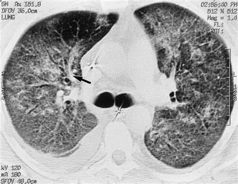 Ct Chest Pulmonary Edema