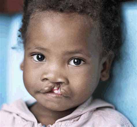 Mission Possible - Operation Smile South Africa