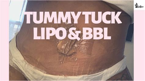 Tummy tuck, lipo & BBL: At home CARE & RECOVERY after TT and Brazilian Butt Lift combo - YouTube