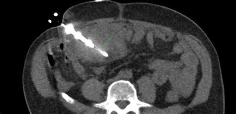 Case 5: Omental Mass Biopsy