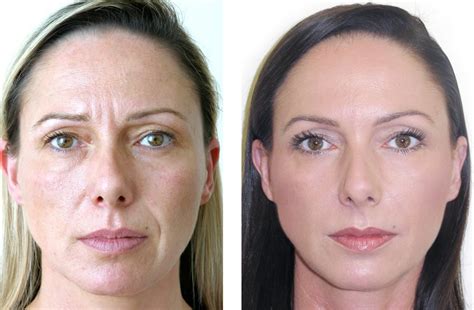 Before & After Filler Injection