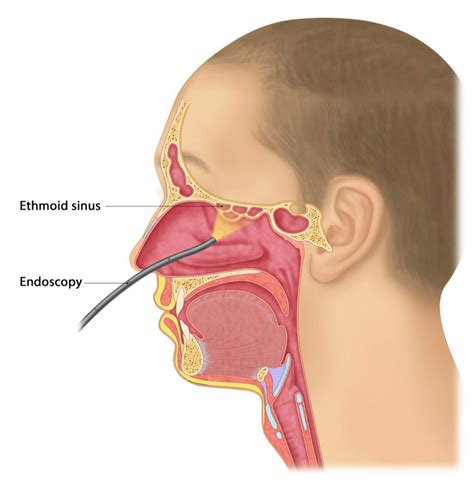 Chronic Rhinosinusitis, Nasal Polyps - Melbourne ENT Group