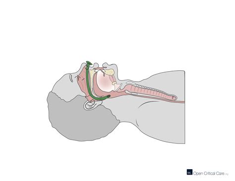 Sagittal cross section view of nasopharyngeal airway - Open Critical Care