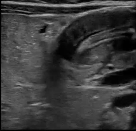 Pyloric Stenosis (Infant with Vomiting) | Emory School of Medicine