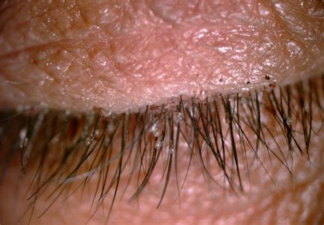 Crab lice infestation in unilateral eyelashes and adjacent eyelids: A case report