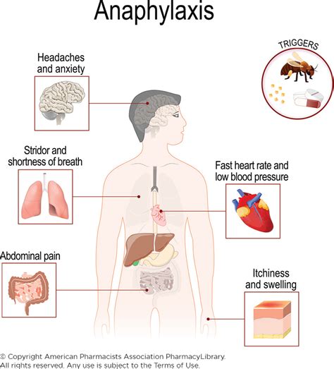 Anaphylaxis Symptoms | PharmacyLibrary