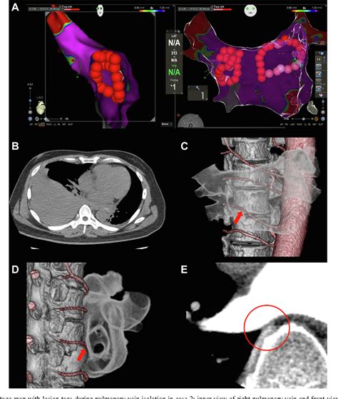 Figure 1 from Severe hemothorax complications during atrial ...