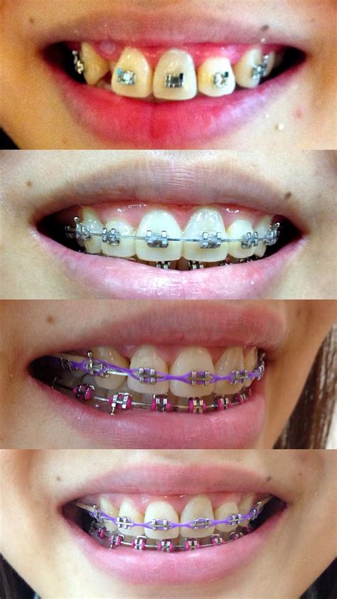 Braces Smile | Braces colors, Dental braces, Teeth braces